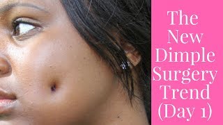 New DIMPLE TREND  Dimple Surgery Day 1 [upl. by Irmgard391]