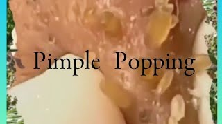 Pimple amp Blackheads Popping  38 [upl. by Akihsal]