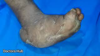 Charcot Foot  Charcot Neuroarthropathy [upl. by Enier]