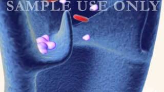 Deep Vein Venous Thrombosis DVT and Pulmonary Embolism PE  3D Medical Animation [upl. by Jueta]