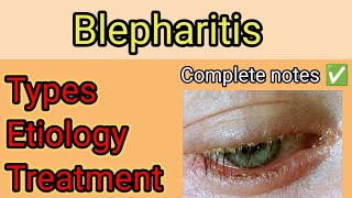 Blepharitis  Eyelid Disorders  Ophthalmology  Shalakya Tantra [upl. by La]