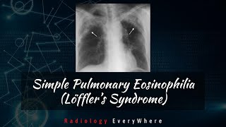 Simple pulmonary eosinophilia  Loffler syndrome  Radiology Tutorials  Radiology Everywhere [upl. by Walters]