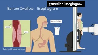 Barium swallow fluoroscopy test [upl. by Berner182]