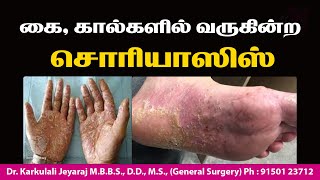 PALMOPLANTAR PSORIASIS  கை கால்களில் சொரியாசிஸ்  JKT SKIN psoriasis treatment medicine [upl. by Dolan]