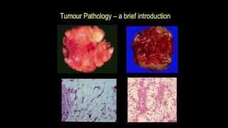 Tumour pathology  a brief introduction part III [upl. by Kerrill271]