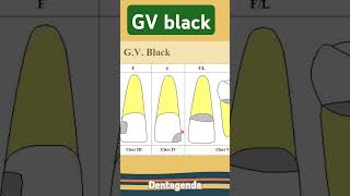 GV black class III IV V [upl. by Aekahs259]