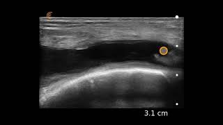 Knee Effusion Ultrasound Image Interpretation [upl. by Baras]