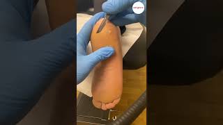 Thick Heel Skin Callus Removal With A Scalpel In Podiatry Clinic [upl. by Kiyohara]