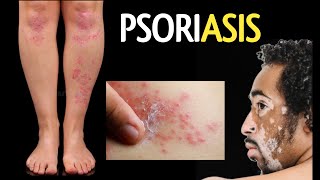 Psoriasis types symptoms causes  सोरायसिस क्या है क्यों होता है कारण लक्षण प्रकार  सोरायसिस [upl. by Gronseth]