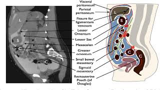 peritoneal and retroperitoneal spaces [upl. by Nagol]