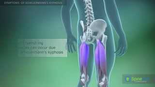 Scheuermann’s kyphosis Symptoms [upl. by Llereg]