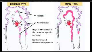 Lesión renal aguda necrosis tubular aguda pt 2 [upl. by Eiruam]