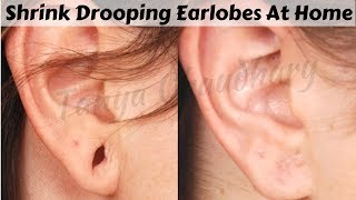 Top 3 Home Remedies To Shrink Drooping Earlobes Naturally At Home  100 Effective Home Remedies [upl. by Lledal]