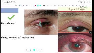 Eyelid Diseases OPH [upl. by Duma]