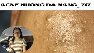 Acne Treatment Huong Da Nang 717  Remove Blackheads [upl. by Ynnavoeg896]