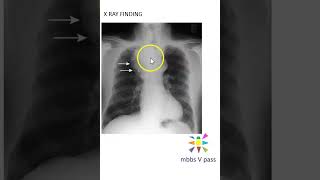 Medicine xray intrathoracic goitre image guess viva chest thyroid enlarged [upl. by Aikaj545]