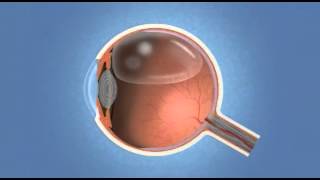 Vitrectomy  Eye Associates of Colorado Springs [upl. by Symon716]