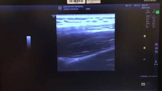 Suprascapular Nerve Block Ultrasound Guided [upl. by Christean]