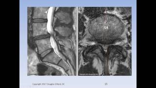 Lumbar Spinal Stenosis Cauda Equina Syndrome Sciatica amp Disc Herniation An Advanced Lecture [upl. by Petrine]