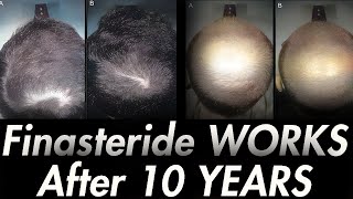 10 YEARS ON FINASTERIDE Results of Italian Study [upl. by Thgiled843]