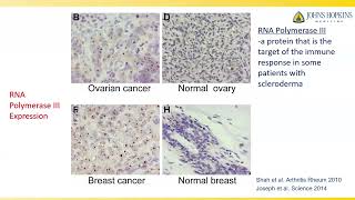 Scleroderma and Cancer What are the Connections Laura K Hummers MD ScM [upl. by Rind]