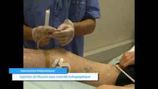 Traitement non chirurgical des varices par injection de mousse sclérosante  Dr Gobin Lyon [upl. by Ycnaf]