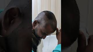 Head wash kaise Kiya jata haihairtransplant hairgrowth hairtransplantation trending ytshorts [upl. by Adelbert70]