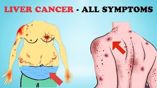 Common Signs and Symptoms Of Liver Cancer  Healthy Care [upl. by Alyacim868]