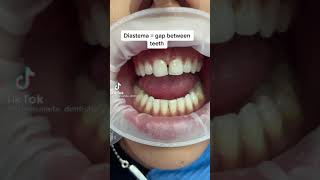 Best way to fix a Diastema  Gap Between Teeth [upl. by Acinoed]