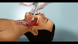 Pediatric Endotracheal Intubation by J Nagler et al  OPENPediatrics [upl. by Aneet]