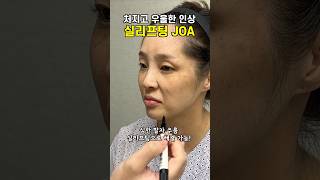 나이들면서 자꾸 처지는 얼굴살로 깊어지는 팔자주름 ㅠㅠ 실리프팅 하기 joa clinic Thread Lift [upl. by Purington]