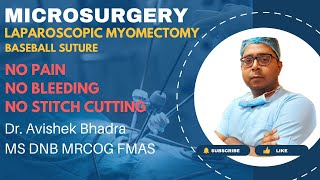 Laparoscopic Myomectomy and Baseball Suturing in a case of Fibroid Uterus [upl. by Crawford]