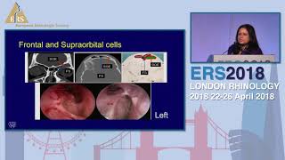 ERS London 2018 How I Do It  A Stepwise Approach To Frontal Sinus Surgery Devyani Lal [upl. by Eilyw]