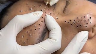 Treatment Of Blackheads And Hidden Acne 037 [upl. by Notsecnirp]