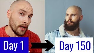 5 MONTH MINOXIDIL BEARD TRANSFORMATION [upl. by Ellivnarg]