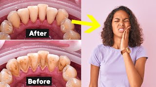 Deep Teeth Cleaning Recovery Tips How To Heal Fast [upl. by Plato269]