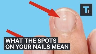 What white marks on nails mean about health [upl. by Milissent214]