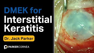 DMEK for Interstitial Keratitis [upl. by Narhet723]