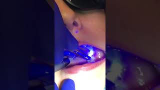 MEDENCY Triplo Blue laser 450nm Operculectomy [upl. by Oeht84]