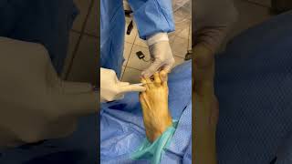 Minimally invasive hammertoe surgery sportsmedicine minimallyinvasivesurgery [upl. by Ddene622]