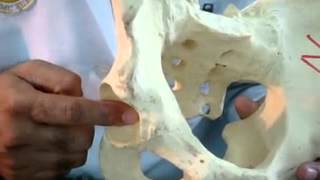 Salter’s innominate Osteotomy in Developemental Dysplastic Hip on Saw Bone Model [upl. by Perri]