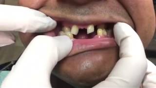 Houston Cosmetic Dentist  underbite for Snapon Smile  and you can eat [upl. by Polard]