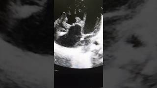 Case 24 echocardiography Ebsteins anomaly in 1 day old baby  born yesterday [upl. by Gram770]