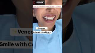 Fluorosis Stained Teeth Treated with Porcelain Veneers shorts cosmeticdentistry dentist yt [upl. by Wilonah]