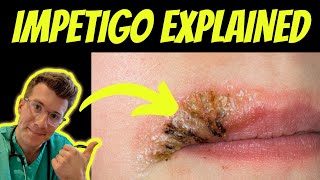 Doctor explains impetigo  causes types and treatment  REAL PHOTOS  Doctor ODonovan [upl. by Schug868]