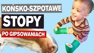 STOPY KOŃSKOSZPOTAWE po gipsowaniu METODA PONSETIEGO dysplazja diastroficzna [upl. by Paver]