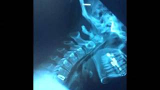 Cervical Disc Replacement using a Baguera Titanium Disc at C6  C7 [upl. by Meakem]