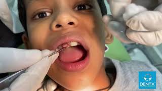 DrKiranKoora Pediatric Dentist  Operculectomy Procedure [upl. by Hewes]