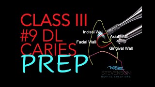 Class III Composite Preparation 9 DL Preparation [upl. by Haldis]