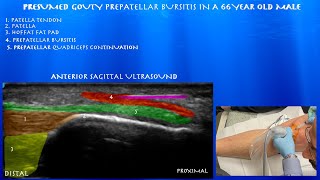 Ultrasound Guided Cortisone Injection for Presumed Gouty Prepatellar Bursitis in a 66 Year Old Male [upl. by Kolva]